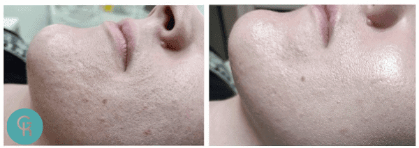 Skóra twarzy przed i po zabiegu peelingiem chemicznym