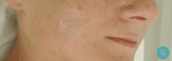 Złuszczanie skóry na policzku po peelingu chemicznym